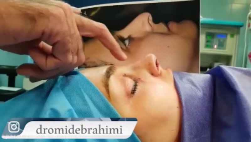 عمل بینی استخوانی توسط دکتر امید ابراهیمی بهترین جراح بینی استخوانی