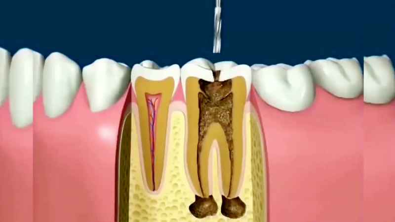 فیلم عصب کشی دندان آسیاب - فیلم مراحل عصب کشی دندان - دندانپزشکی کوروش