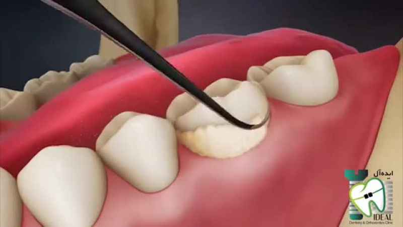 پلاک های دندانی | کلینیک دندانپزشکی ایده آل