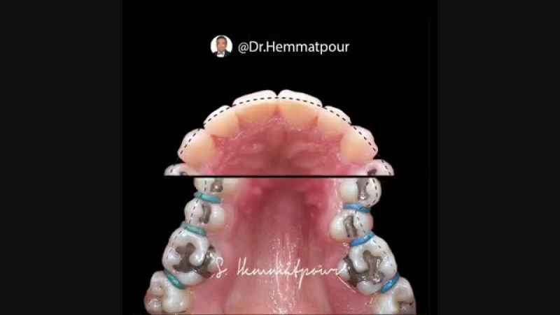 گسترش قوس دندانی فقط توسط ارتودنسی | دکتر سیامک همت پور