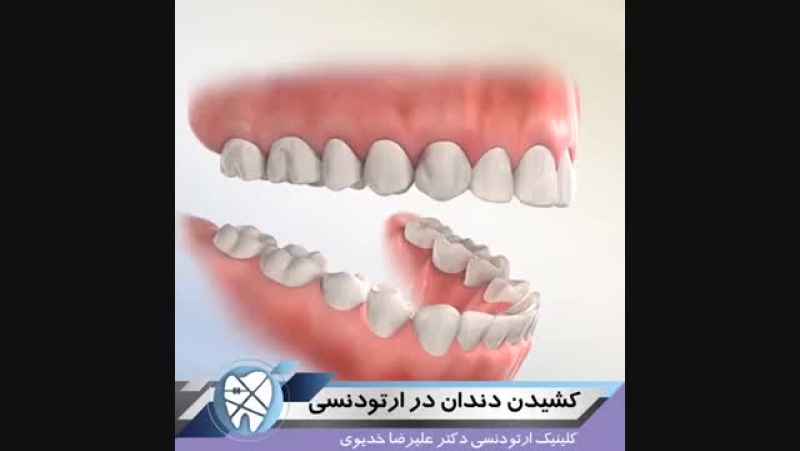 کشیدن دندان در ارتودنسی.متخصص ارتودنسی تهران،دکتر علیرضا خدیوی