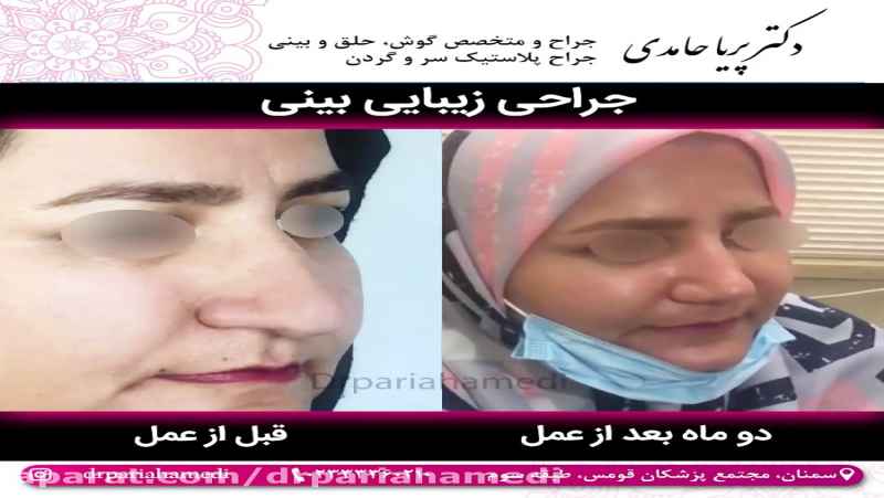 قبل و بعد از جراحی بینی | جراح بینی سمنان | دکتر پریا حامدی