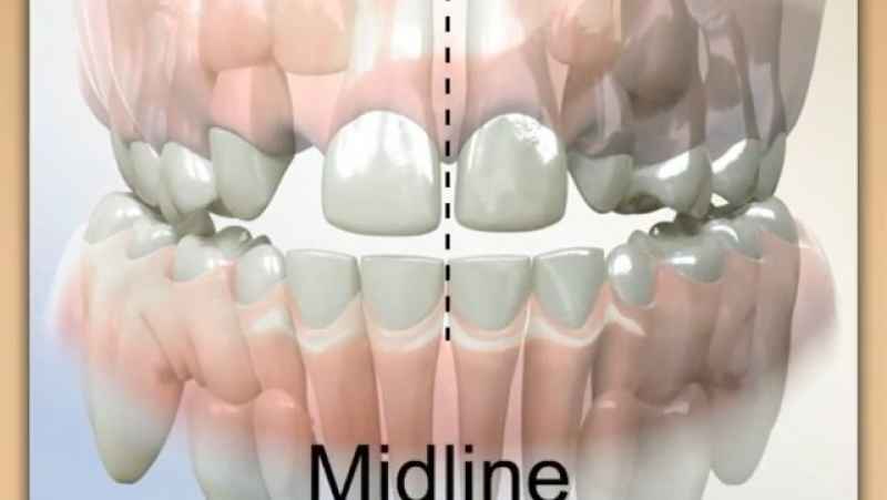 میدلاین به خط وسط قوس دندان های بالا و پایین گفته می شود | دکتر فرهاد گرجی