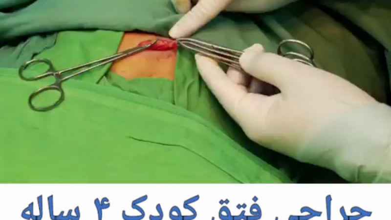 انجام عمل جراحی فتق کودک 4 ساله در مرکز جراحی محدود ایرانیان